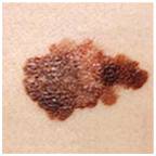 опасная родинка (меланома)