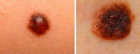 какие родинки опасны