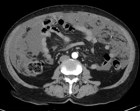 kanceromatoz bryushiny