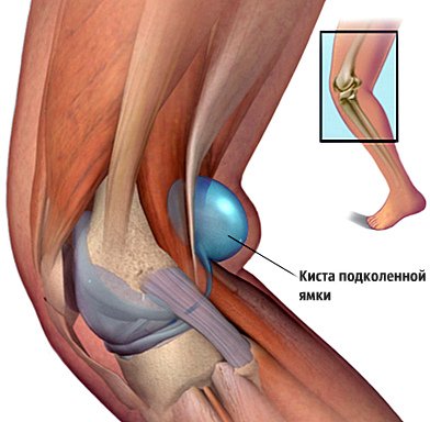 kista podkolennoj yamki