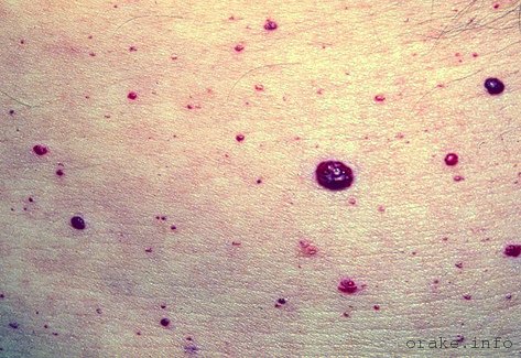 красные родинки