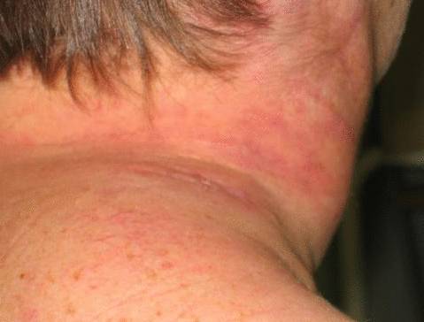 Крупноклеточная лимфома