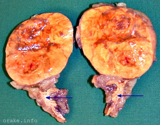 lechenie adenomy nadpochechnika