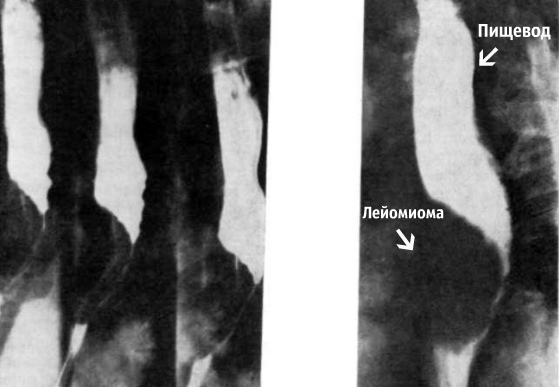lejomioma pishhevoda