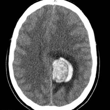 Лимфома мозга: виды и лечение