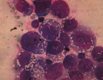 Лимфома костного мозга