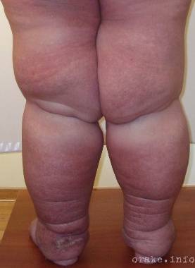 Лимфостаз конечностей при раке: устранение