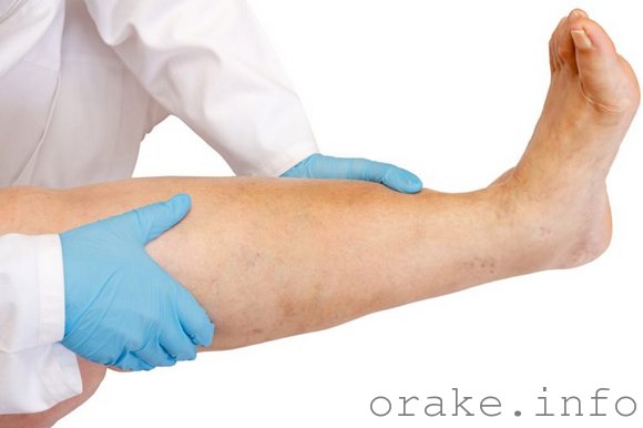 Лимфостаз конечностей при раке: устранение