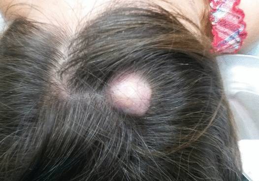 Липома на голове - фото