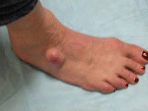 Липома на ноге фото