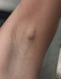 Липома под мышкой - фото