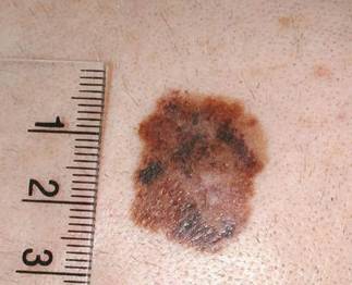 Меланома фото начальная стадия Меланома фото начальная стадия