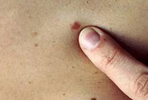 Стадии меланомы - фото