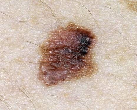 Меланома - фото начальная стадия.