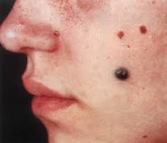 Меланома кожи - фото начальная стадия