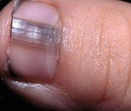 Меланома ногтя фото начальная стадия