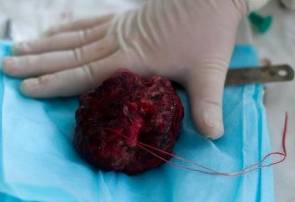 менингиома после удаления