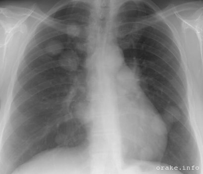 metastazy melanomy v legkix