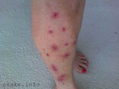 метастазы на коже