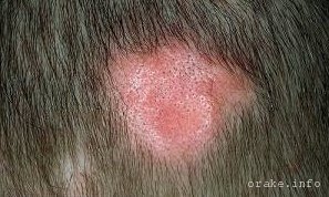 метастазы под кожей