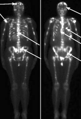 Метастазы - сколько осталось жить?