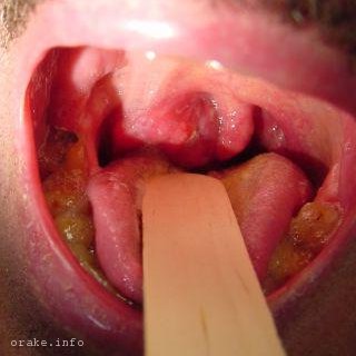 метастазы в горле