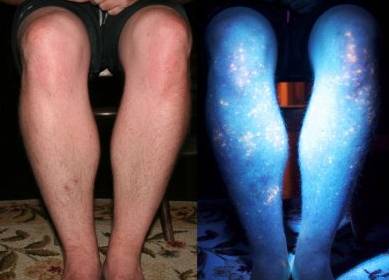 Метастазы - сколько осталось жить?