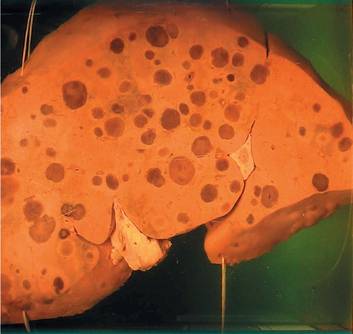 Метастазы в печени - прогноз срока жизни