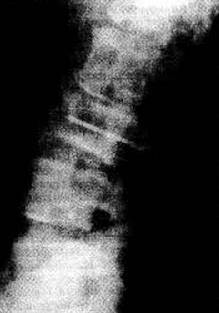 Миеломная болезнь