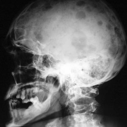 Миеломная болезнь - лечение