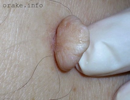 мягкая фиброма