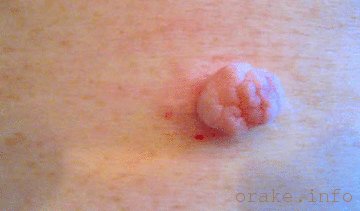 мягкая фиброма