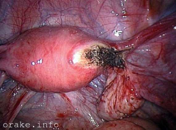 nekroz miomatoznogo uzla