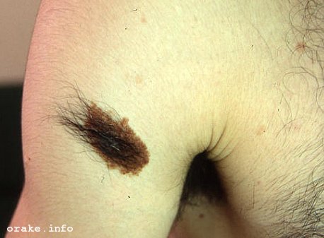 nevus bekkera