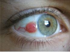 невус глаза