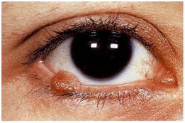 невус глаза