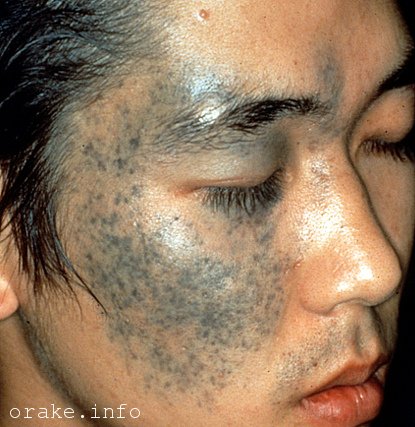 nevus ota mozhet perejti v rak