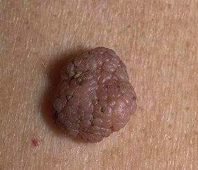 Новообразование у женщин