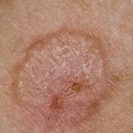 Новообразования на коже (базалиома)