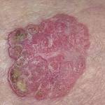 Новообразования на коже (болезнь Боуэна)