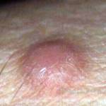 Новообразования на коже (дерматофиброма)