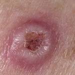 Новообразования на коже (Кератоакантома)
