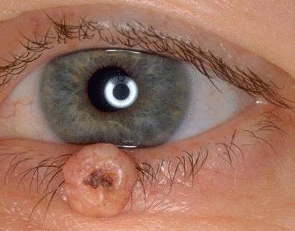 novoobrazovaniya vek - keratoakantoma