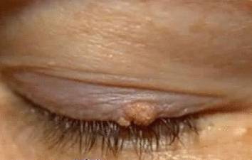 Новообразования век