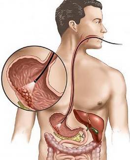Онкология желудка - диагностика