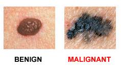 опасные родинки