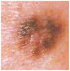 опасные родинки