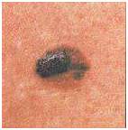 какие родинки опасны