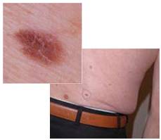 опасные родинки