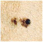 какие родинки опасные